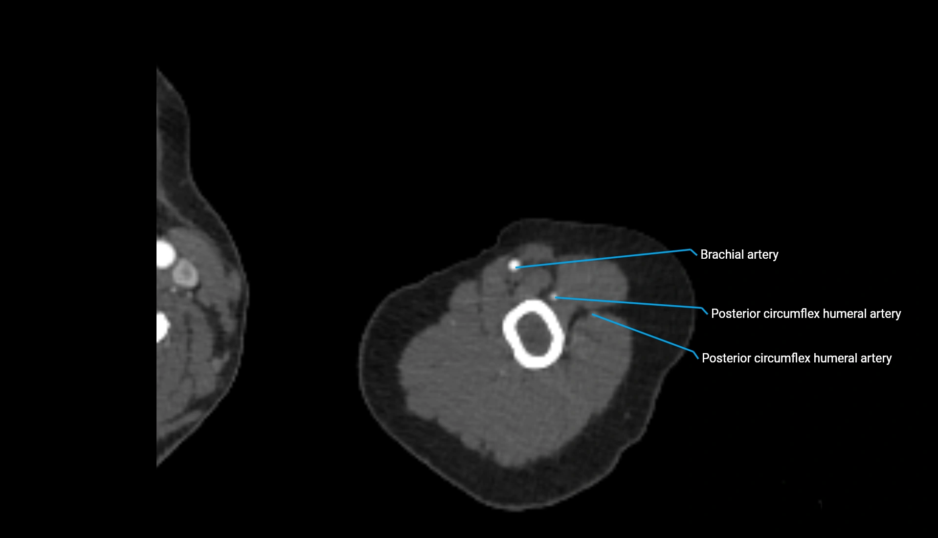 CTA upper limb axial cross sectional anatomy labelled image 303 (2).webp